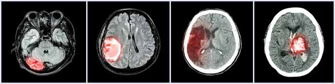head and brain injury